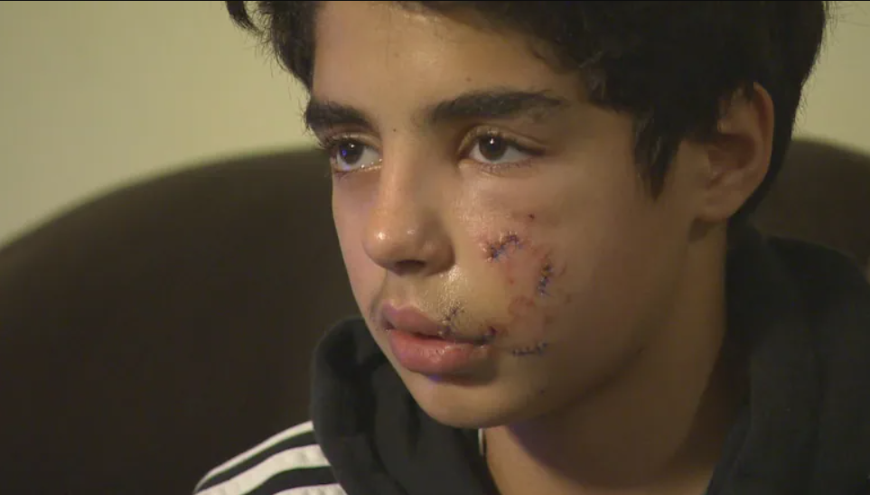 Teen-allegedly-attacked-by-dog